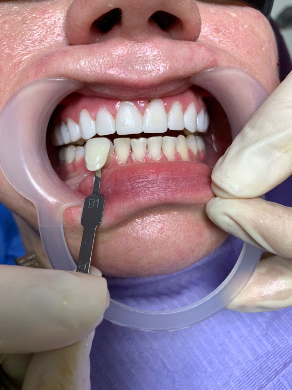 Диета после отбеливания зубов: что можно и нельзя, сроки — ROOTT