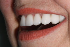 протезирование зубов ростов