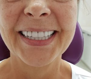 виниры в стоматологии 